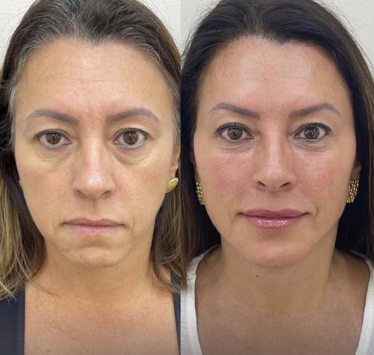 Antes e depois de rejuvenescimento facial conduzido pela Dra. Andressa Rada