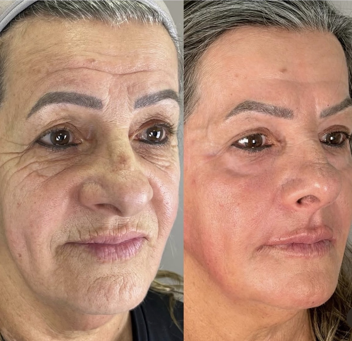 Antes e depois de tratamento facial conduzido pela Dra. Andressa Rada