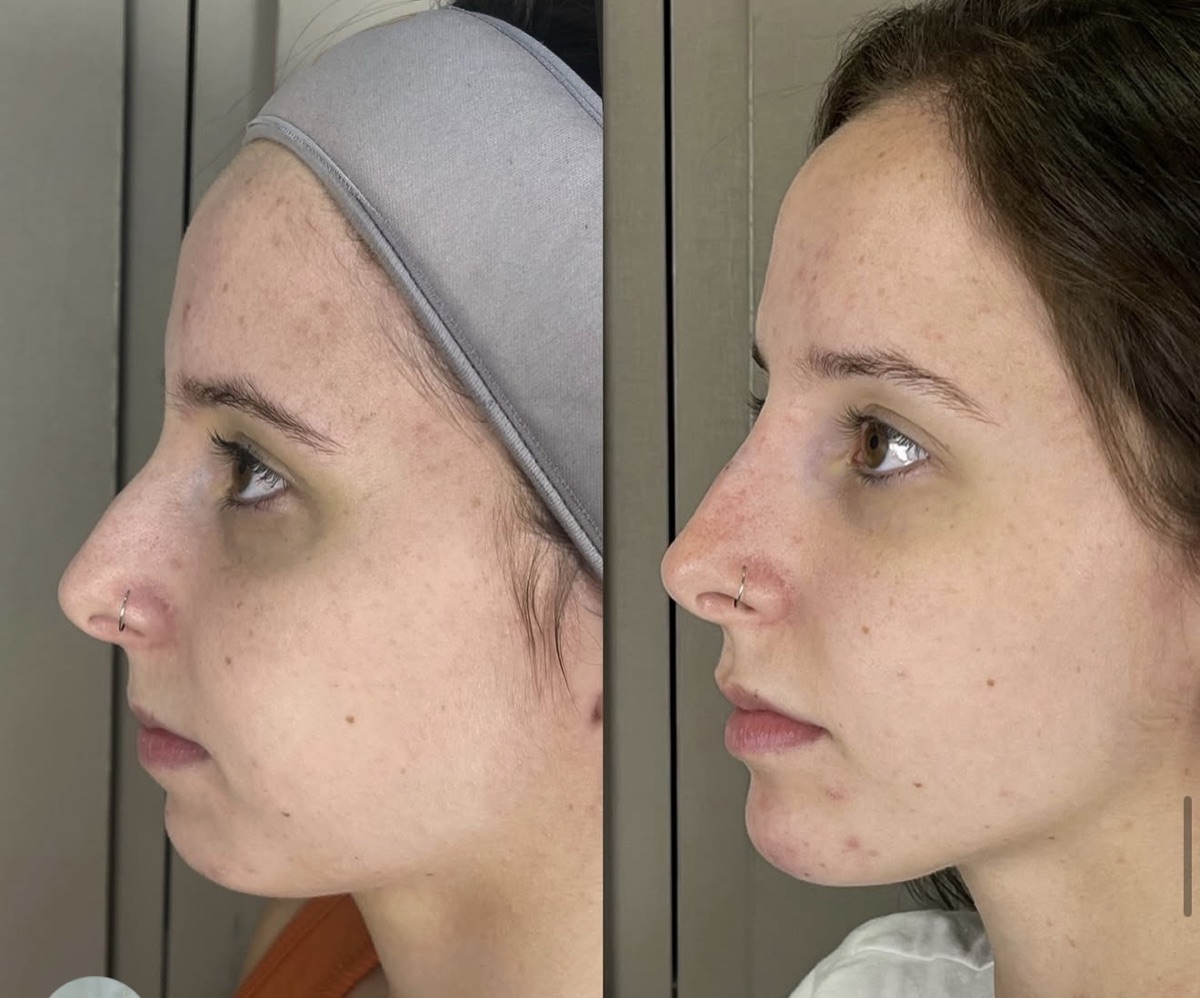 Antes e depois de tratamento conduzido pela Dra. Andressa Rada